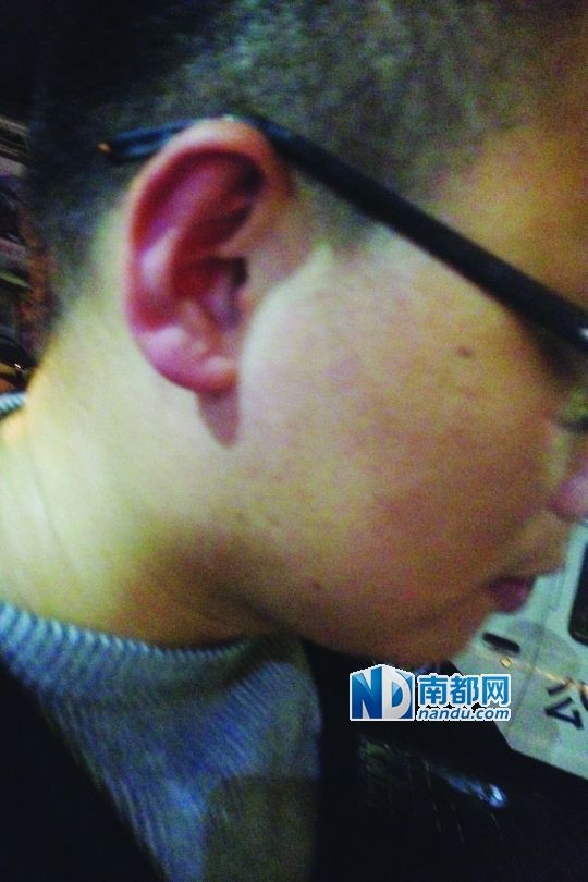 南都记者陈乐伟头部被殴打后出现听力下降、头痛等症状。