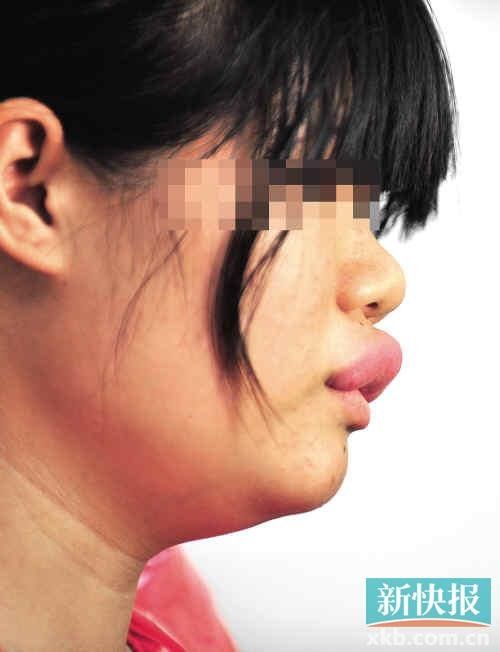 女孩称15年前吃了狗肉嘴唇长成“香肠”(图)