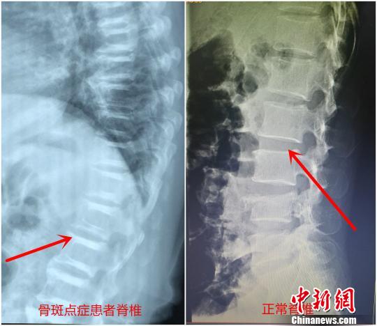 “硬骨头”患者遇骨折 手术堪比在岩石上打洞